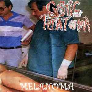 Cystic Teratoma - Melanoma